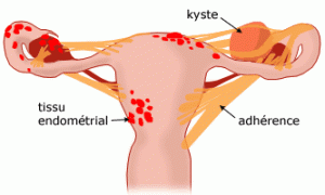 schema-endometriose